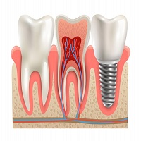 възстановяване след поставяне на зъбни импланти - 71562 възможности