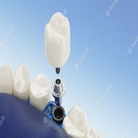 възстановяване след поставяне на зъбни импланти - 58875 цени