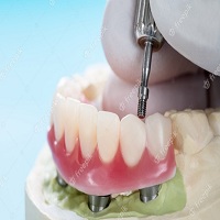 възстановяване след поставяне на зъбни импланти - 4678 възможности