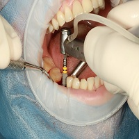 възстановяване след поставяне на зъбни импланти - 20061 селекции
