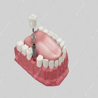 възстановяване след поставяне на зъбни импланти - 55041 вида