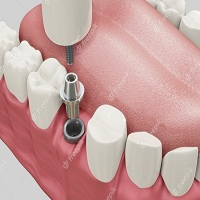 възстановяване след поставяне на зъбни импланти - 69559 типа