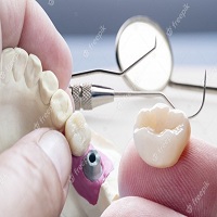 възстановяване след поставяне на зъбни импланти - 37912 варианти