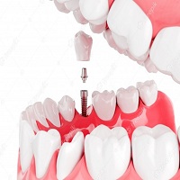възстановяване след поставяне на зъбни импланти - 39925 комбинации