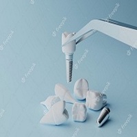 възстановяване след поставяне на зъбни импланти - 8561 снимки